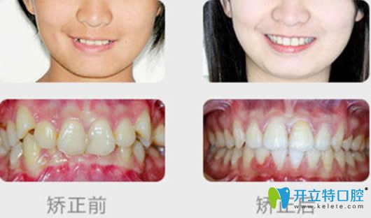 泉州維樂(lè)黃鴻進(jìn)醫(yī)生成人牙齒擁擠矯正前后對(duì)比效果