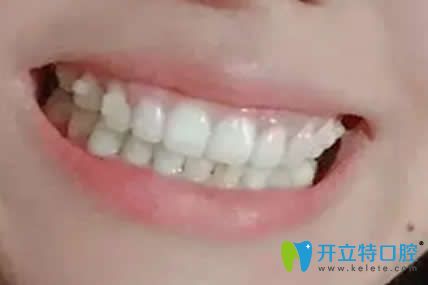 我在漯河舒適美口腔做牙齒矯正1年效果 我在漯河舒適美口腔做牙齒矯正1年效果