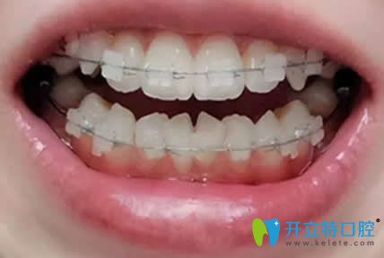 我在漯河舒適美口腔做陶瓷托槽牙齒矯正第3個(gè)月 我在漯河舒適美口腔做陶瓷托槽牙齒矯正第3個(gè)月