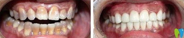 四環(huán)素牙修復后變化圖