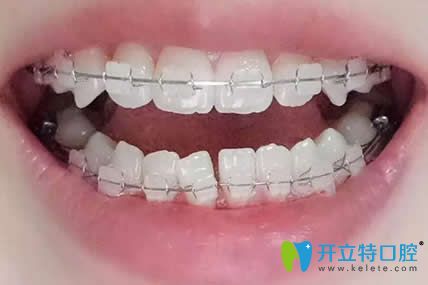 我在漯河舒適美口腔做牙齒矯正戴牙套第9個(gè)月 我在漯河舒適美口腔做牙齒矯正戴牙套第9個(gè)月