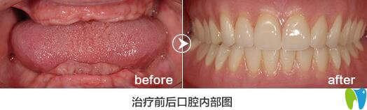 格倫菲爾口腔怎么樣？老年人全口牙缺失種植<span style=