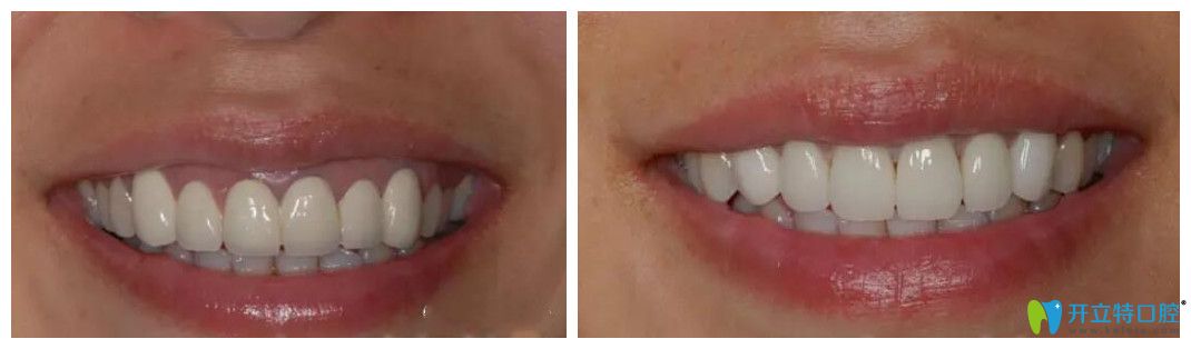 段銀鈴烤瓷牙失敗修復前后效果對比圖