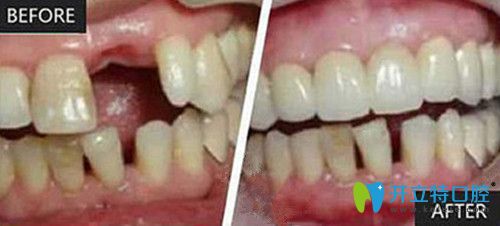 種植牙前后對比圖