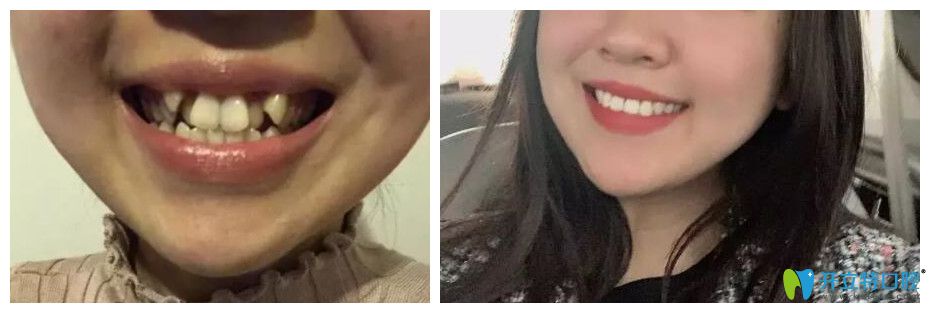 杭州牙齒矯正哪里好？艾芳口腔牙齒擁擠不齊矯正對比圖公布