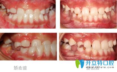 兜齒矯正前后對(duì)比圖 兜齒矯正前后對(duì)比圖