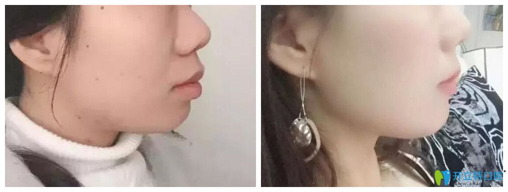 艾芳口腔嘴突齙牙顧客矯正案例前后對(duì)比圖