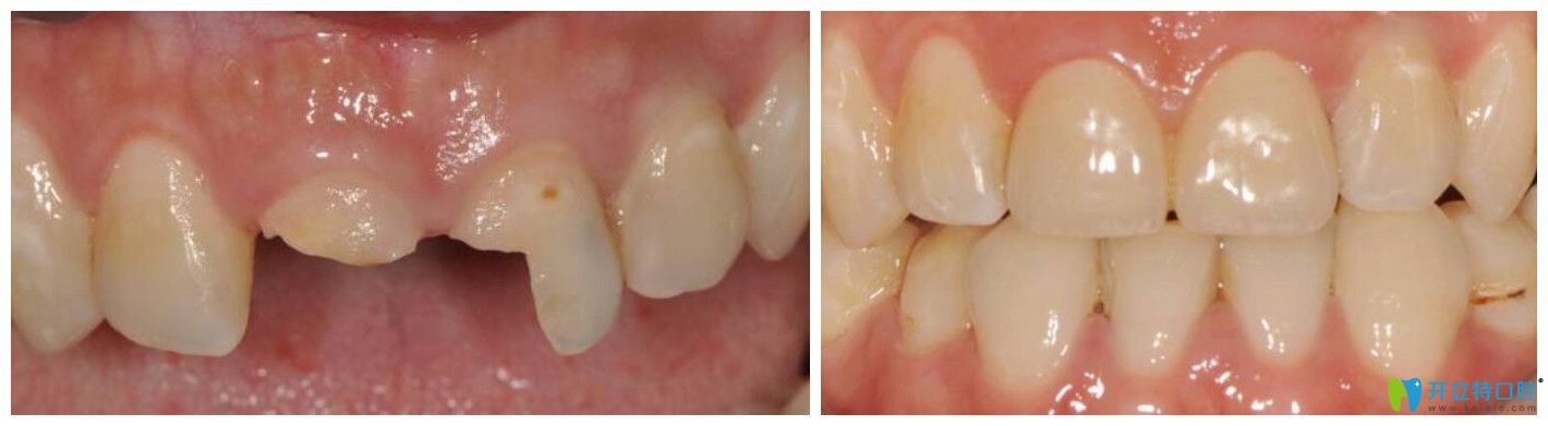 杭州牙科那里便宜又好？來看艾芳口腔門牙修復(fù)案例效果圖