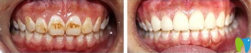 牙齒修復前后效果圖