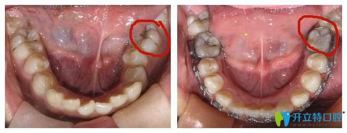 鎖合牙矯正對比圖