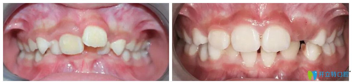 楊素兒童mrc矯正深覆合案例效果對比圖