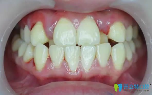 在南陽(yáng)康澤口腔矯正前的牙齒照片