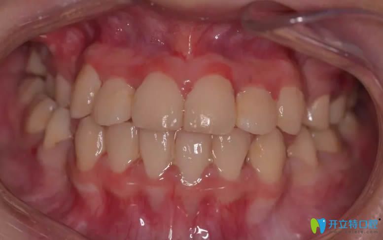 我在南陽(yáng)康澤口腔牙齒矯正后的效果圖