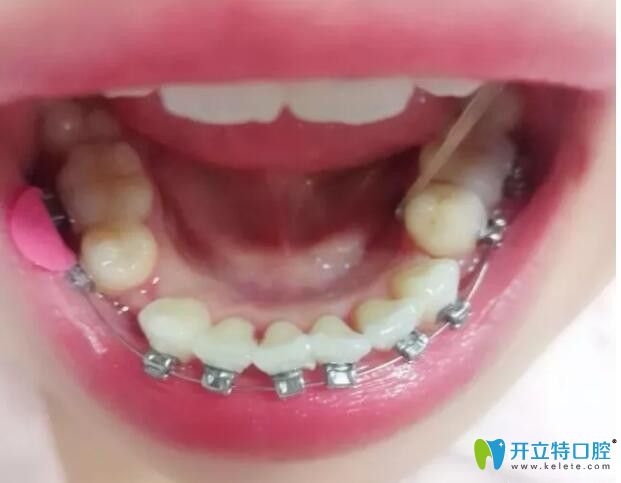 中山禾佳口腔牙齒矯正42天效果圖