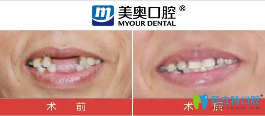 杭州美奧口腔多顆牙缺失種植案例對比圖