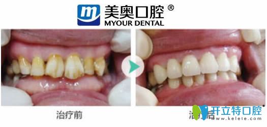 杭州美奧口腔牙齒美白前后對比效果圖