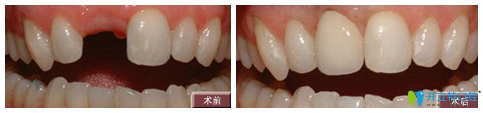 中山禾佳口腔門牙缺失種植案例