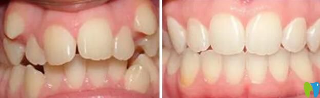 屬于中山禾佳虎牙矯正案例前后對比圖
