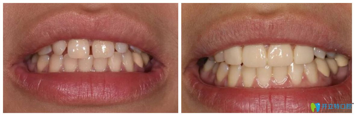 中山禾佳口腔好不好？精品牙科案例公布