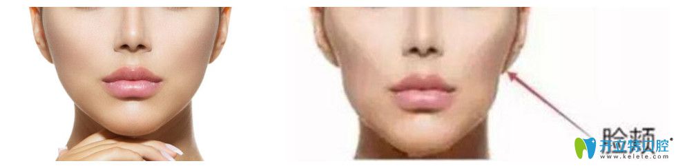 拔了四顆牙臉癟了圖公布，資深牙醫(yī)告訴你該如何避免