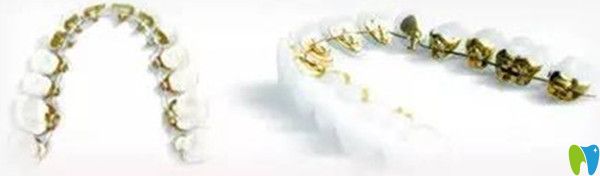 舌側(cè)保持器的優(yōu)缺點(diǎn)