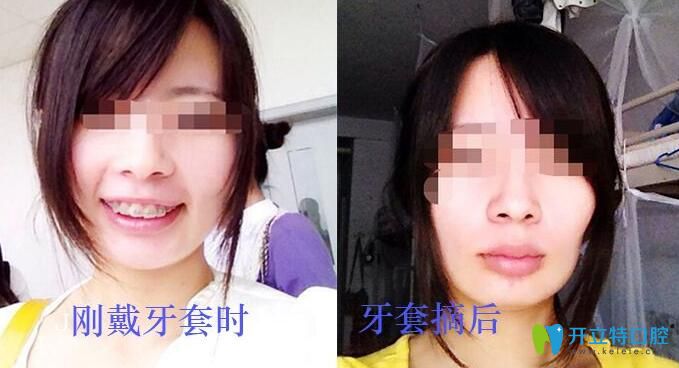 牙套臉會(huì)自行恢復(fù)嗎