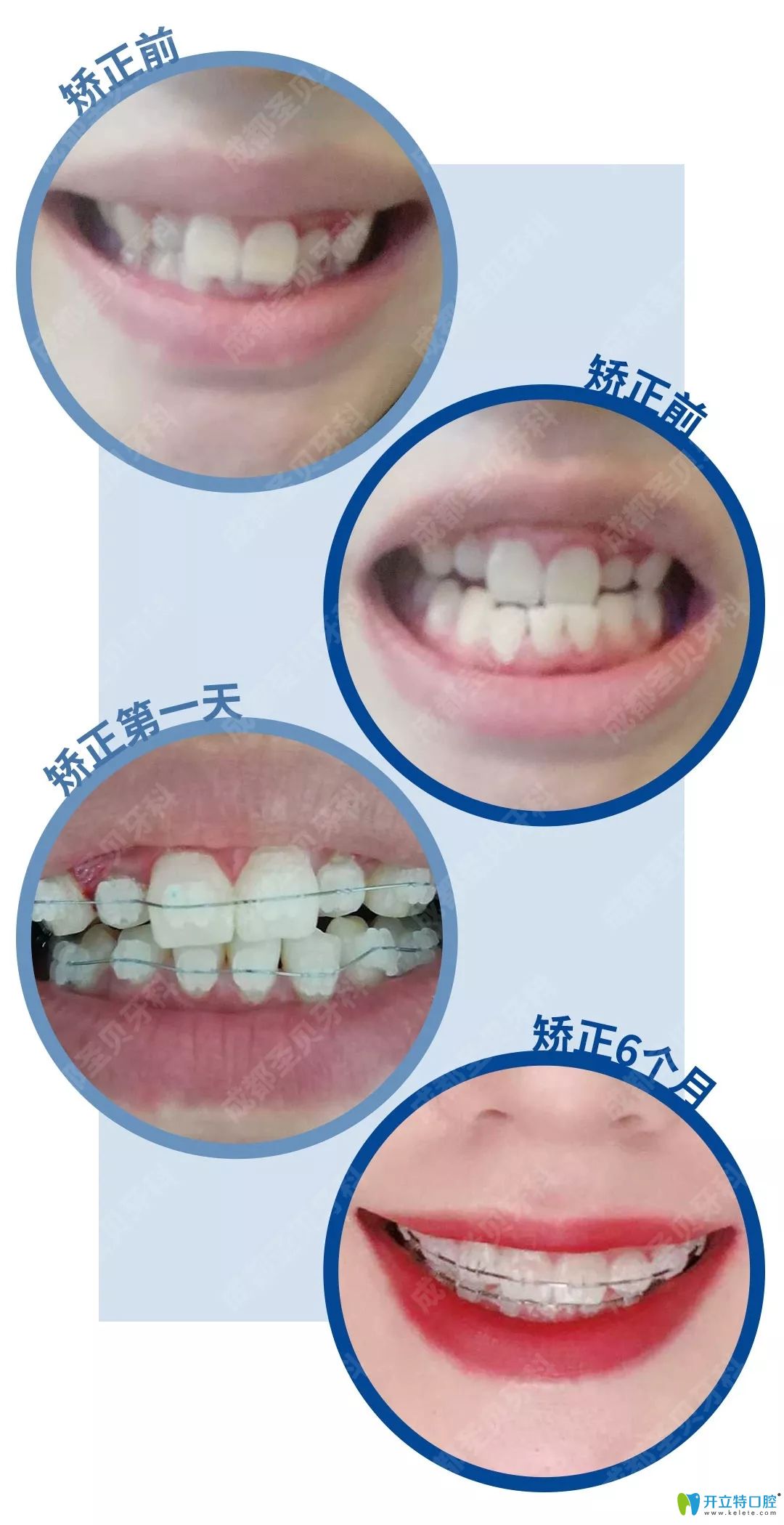 圣貝牙科牙齒不齊矯正1-6個(gè)月變化過程照片