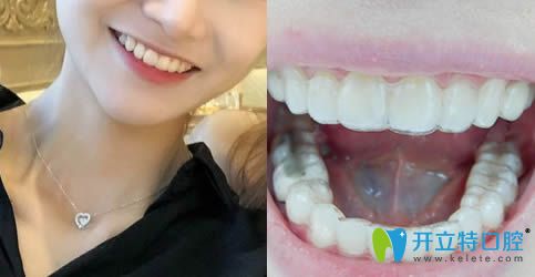 我在安徽維多利亞口腔做隱適美正畸后效果