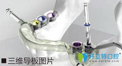 數字化3D導板種植技術