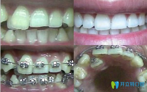 青島維樂(lè)口腔牙齒正畸效果對(duì)比圖