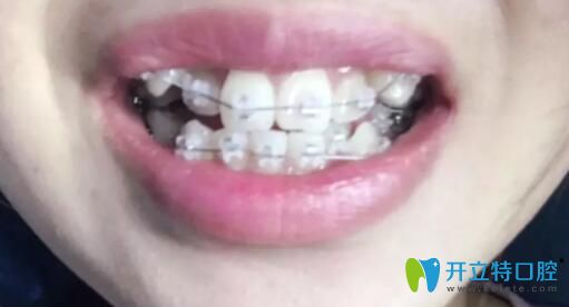 我在鵬博口腔做陶瓷托槽牙齒矯正第3個月