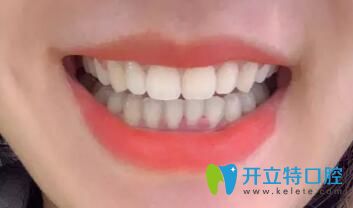 我在鵬博口腔做牙齒矯正15個月效果