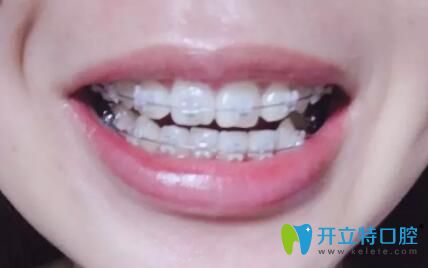 我在松桃鵬博口腔做牙齒矯正第9個月