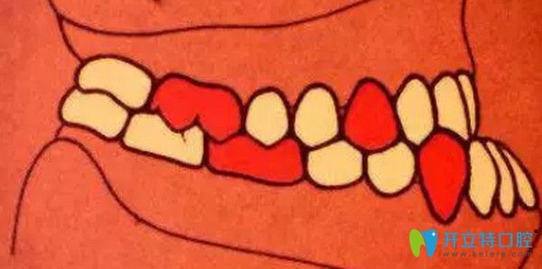 安氏三類錯(cuò)頜  近中錯(cuò)頜