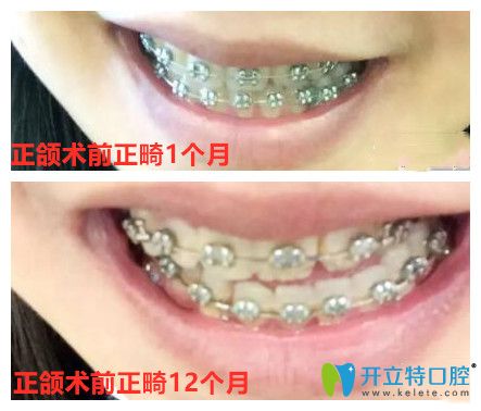 正頜術(shù)前正畸牙齒變化圖
