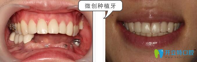 松桃鵬博口腔王鵬院長(zhǎng)種植牙案例