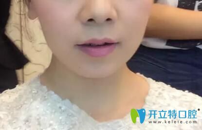 掩飾性正畸后正頜成功經(jīng)驗(yàn)分享