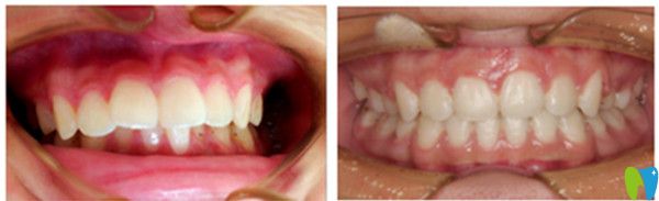 正畸安氏分類詳解及對應的矯正方法