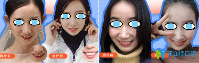 成人虎牙矯正和齙牙矯正前后對比效果圖 成人虎牙矯正和齙牙矯正前后對比效果圖