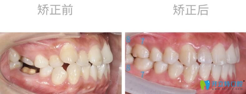 智齒矯正前后側面圖