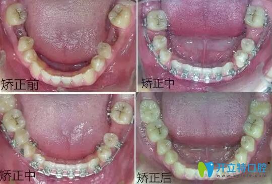 智齒矯正代替磨牙前后對比圖