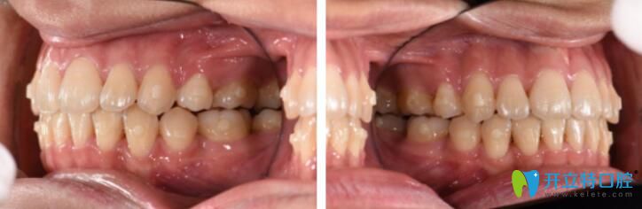 博思美隱形矯正效果好不好？來看看小姐姐的案例