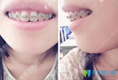 牙齒稀疏的整牙3個(gè)月的效果圖