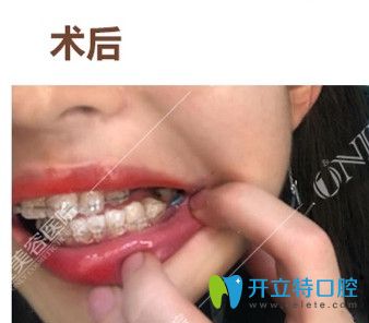 廣州壹加壹初戴牙套