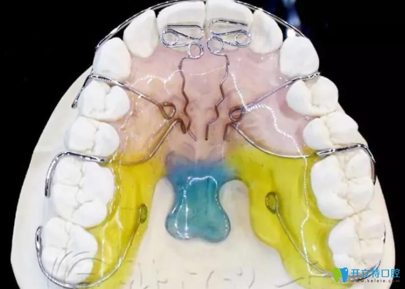 活動矯正器多少錢一個