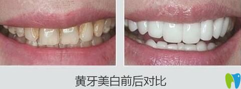 重慶團(tuán)圓口腔牙齒美白效果圖