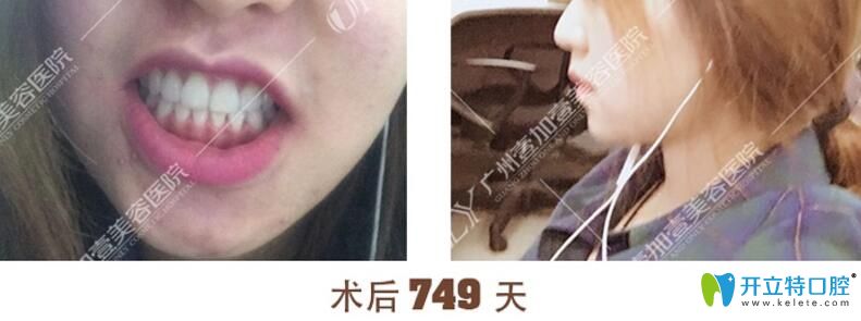 閨蜜在廣州壹加壹口腔做牙齒矯正后效果