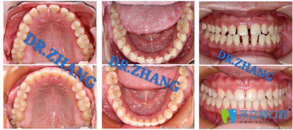 美奧口腔張彼得矯正案例