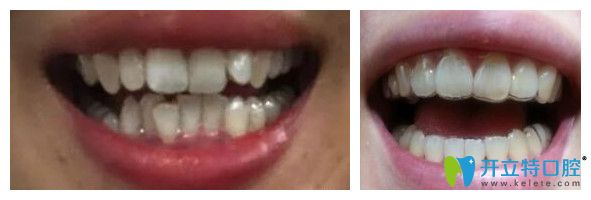 牙齒不齊達(dá)芬奇隱形矯正1到12個(gè)月效果