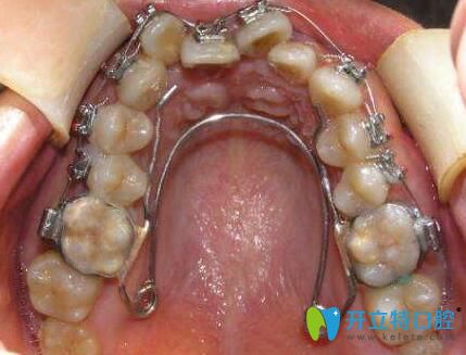 在了解牙弓狹窄怎么矯正前，你還要知道這些……